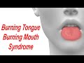 Burning Tongue And Burning Mouth Syndrome Causes And Treatment