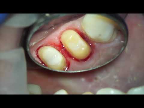Vertical preparation of teeth