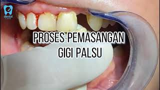 Download lagu Proses pemasangan gigi palsu mp3 Download lagu Proses pemasangan gigi palsu mp3