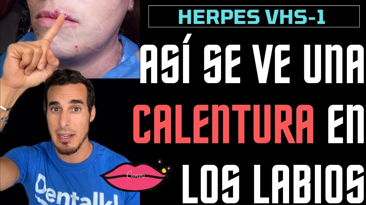 Así se ve un HERPES LABIAL o CALENTURA en la boca - FUEGOS o CULEBRILLA