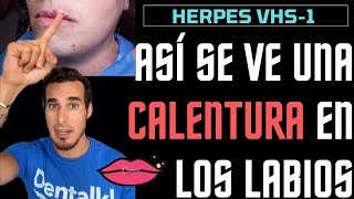 Así se ve un HERPES LABIAL o CALENTURA en la boca - FUEGOS o CULEBRILLA