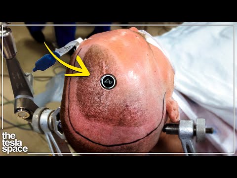 Neuralink Reveals Results Of First Human Trial!