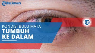 Trikiasis, Kondisi Penyakit Mata yang Terjadi karena Bulu Mata Tumbuh ke Arah Dalam Mata