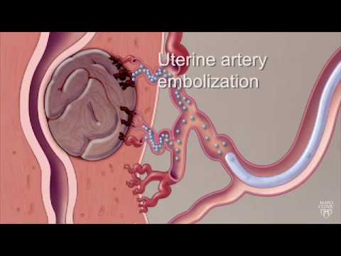 fibroids és paraziták kezelése