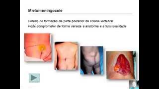 Prevenção de Malformações do Sistema Nervoso