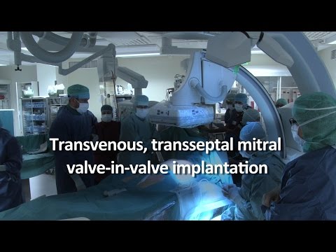 Transvenous, transseptal mitral valve in valve implantation