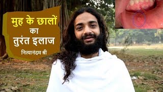 MOUTH SORES INSTANT CURE | AYURVEDIC REMEDY FOR MOUTH ULCER BY NITYANANDAM SHREE