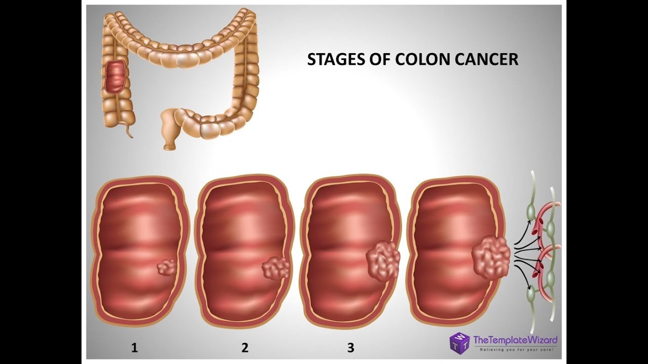 Colon Cancer PowerPoint Presentation Template - TheTemplateWizard.com