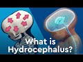 What is Hydrocephalus and Why Does Fluid Build Up in the Brain?