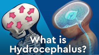 What is Hydrocephalus and Why Does Fluid Build Up in the Brain