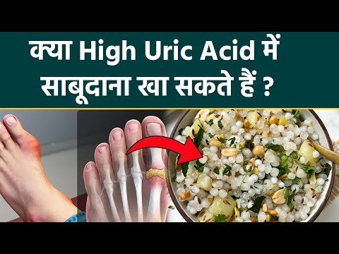Is Sabudana Good For Uric Acid: High Uric Acid Me Sabudana Khana Chahiye Ya Nahi | Boldsky