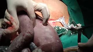 Caesarean section with  breech delivery- Dr Rahul Jadhao