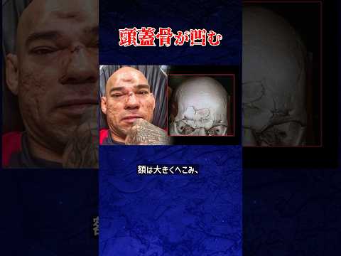 飛び膝で頭蓋骨陥没の衝撃KO【格闘技解説】