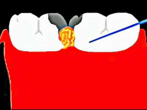 tooth cavity-- दांतों में कीड़े लगने के कारण ,दांतों में खडडे