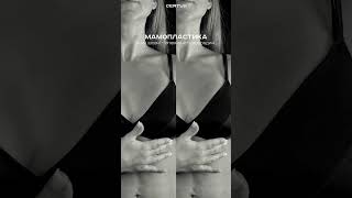 Мамопластика (Збільшення грудей) 21