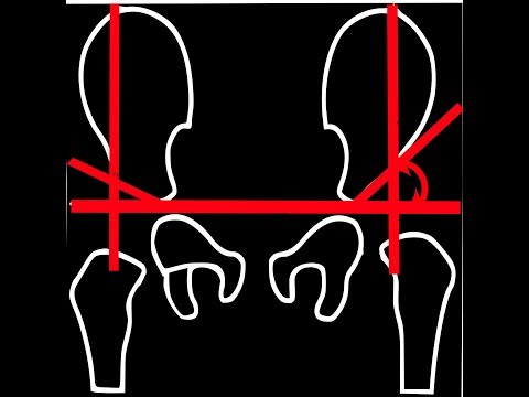AcetabularIndexApp video thumbnail