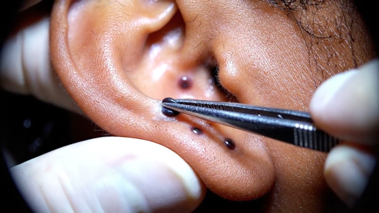 #PimplePixy #AcneClean #SatisfyingExtraction #PimplePopping #skincareasmr