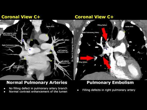 CT Angiography Normal Vs Pulmonary Embolism | Polo Mint, Railway Track Signs | Acute & Chronic Types