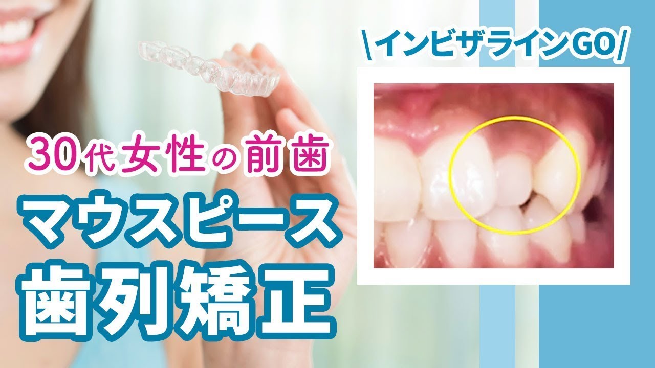 自然で目立たない!!マウスピースを使った歯列矯正 How I Straighten My Teeth With A Mouthpiece