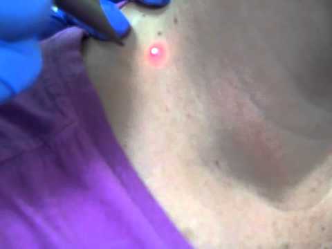 Skin Tag Removal - Hormone Health and Weight Loss 2015