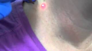 Skin Tag Removal - Hormone Health and Weight Loss 2015