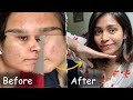 This Changed My Life No Product No Doctor Acne Journey Tamil