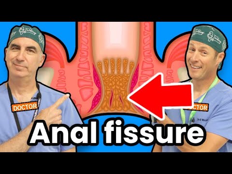 What Is An Anal Fissure