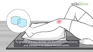How to Get Rid of Bruises