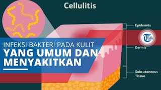 Selulitis (Cellulitis), Infeksi Bakteri Kulit yang Umum, Menyakitkan, dan Timbulkan Warna Kemerahan