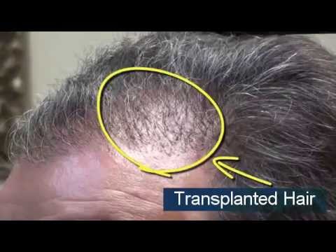 How Natural Will My Hair Transplant Look? Video