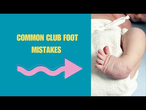Common Club Foot Mistakes Parents Make | Do This Instead. Stretches To Correct Club Foot.