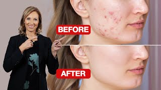 Acne Rosacea | How to Get Rid of it Fast | Dr. Janine