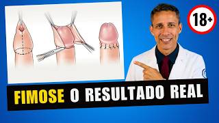 Fimose: saiba tudo antes da cirurgia! COM IMAGENS REAIS | Veja antes de operar