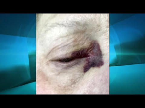 On Blood Thinners? Be Aware of Purpura