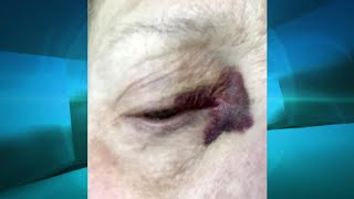 On Blood Thinners? Be Aware of Purpura video