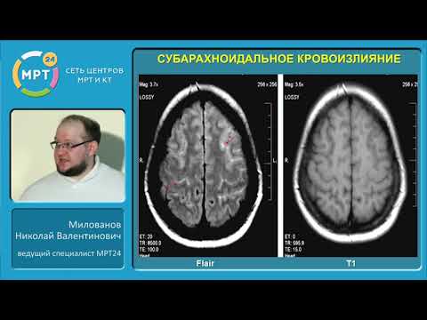 Мильгамма при шейном остеохондрозе Узи сосудов шейного отдела пенза