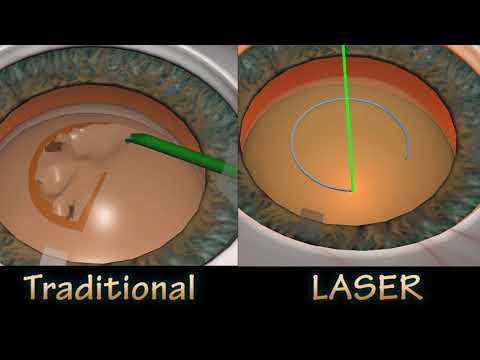 FLACS VS TRADITIONAL CATARACT SURGERY -  Rhexis Compare