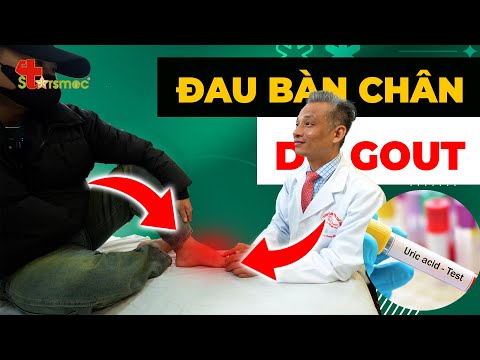 Đau Bàn Chân Do Gout: Cách Điều Trị Nhanh Chóng và Hiệu Quả Nhất