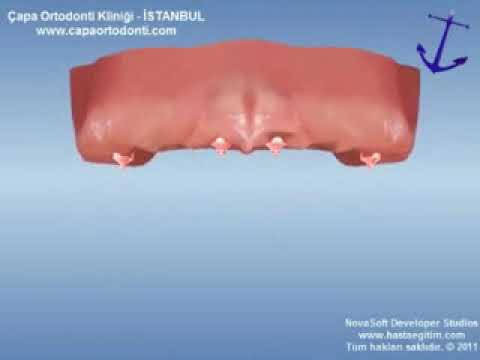 Overdenture, Overdenture Nedir?