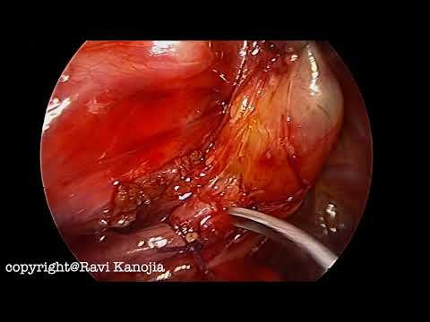 Upper Pouch Dissection in TREAT