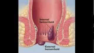 Hemorrhoids: An Overview | Los Angeles Colonoscopy