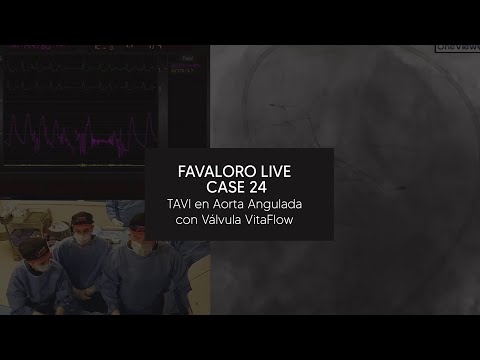 Favaloro Live Case N° 24 - TAVI en Aorta Angulada con Válvula VitaFlow