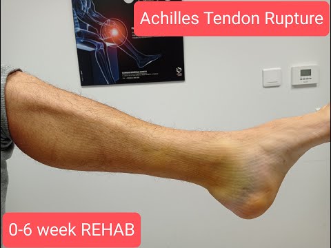 Achilles tendon rupture. 0-6 week Rehabilitation protocol. Riabilitazione rottura tendine d'Achille.