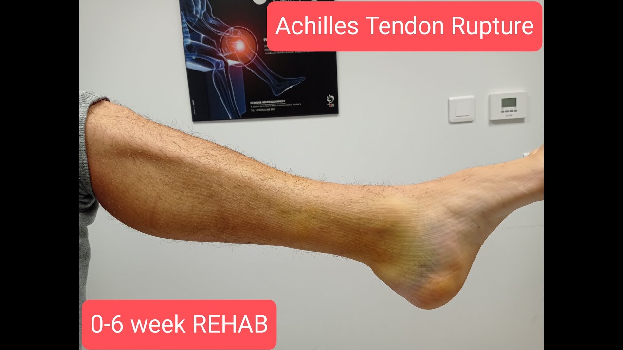 Achilles tendon rupture. 0-6 week Rehabilitation protocol. Riabilitazione rottura tendine d'Achille.