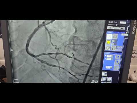 TAP technique- RCA bifurcation stenting