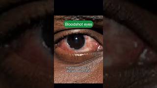 Bloodshot Eyes🩸😱