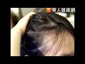 女子經常染髮　毛囊萎縮長髮全掉光　