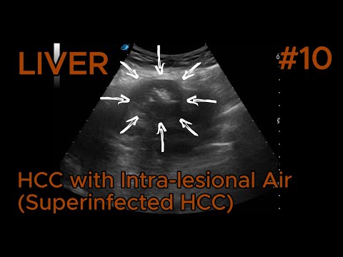 Liver – Hepatocellular Carcinoma with Intra-lesional Air (Superinfected HCC) – Clip 1 B-mode