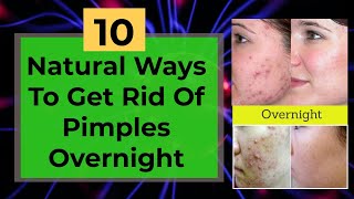 10 Natural Ways To Get Rid Of Pimples Overnight || 100% works