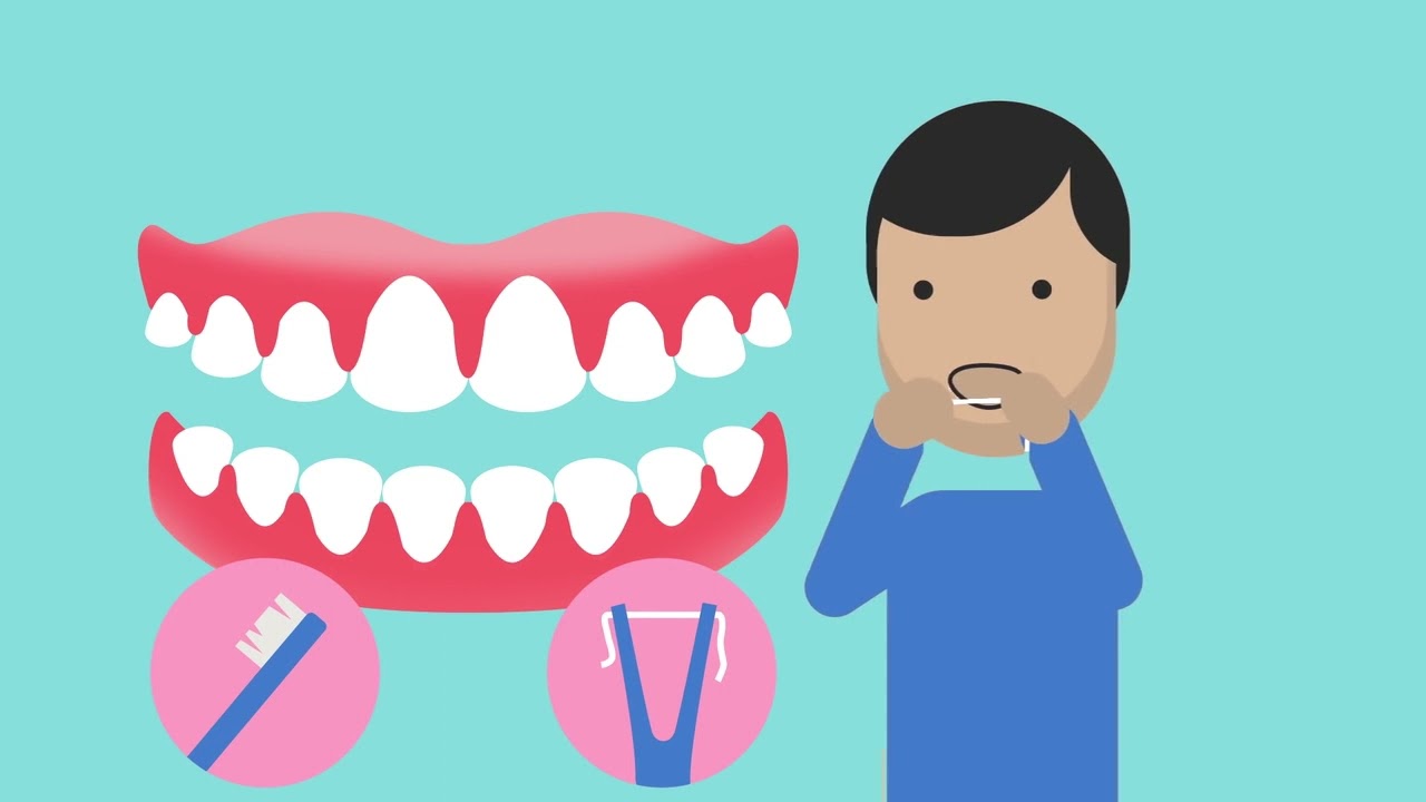 What is Gingivitis